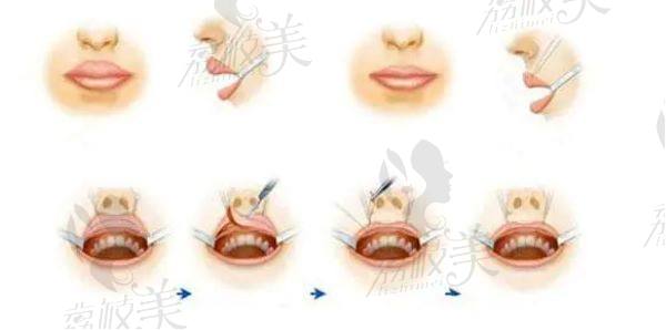 佛山华美医院厚唇改薄唇怎么样