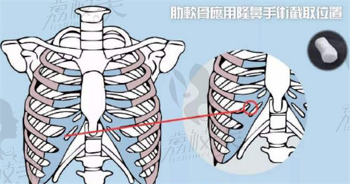 肋软骨隆鼻