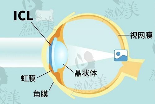 北京何氏眼科医院ICL晶体植入术