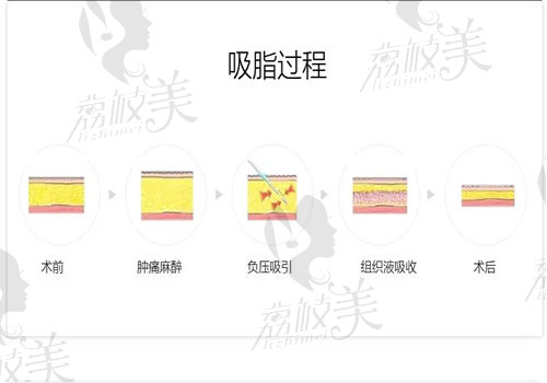 深圳八大处黄奔上臂吸脂实例