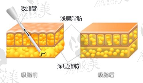 北京冯斌医生吸脂手术