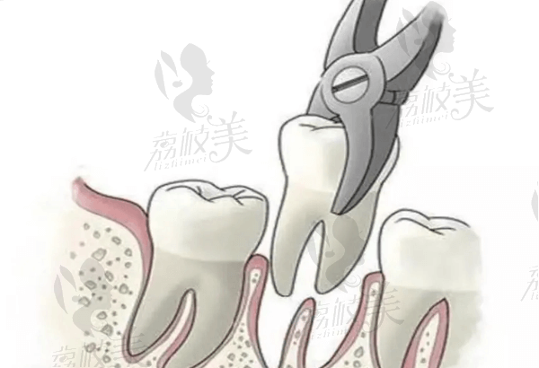 拔智齿注意事项