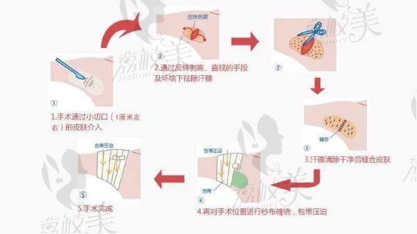 小孩做狐臭手术需要多少钱