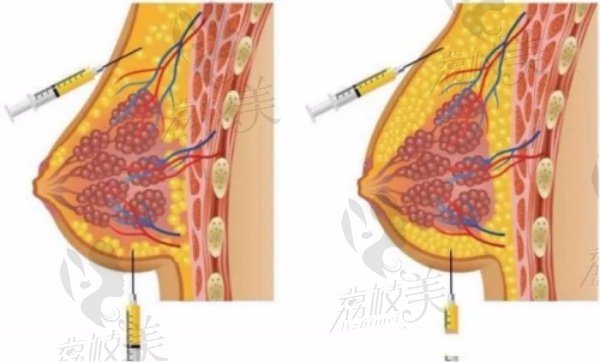 杭州薇琳郭同荣脂肪丰胸技术优势