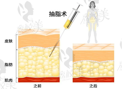 重庆松山医院抽脂价格不贵