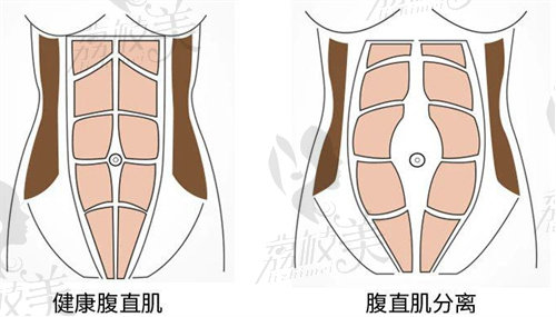 四川现代医院腹壁成形术好不好