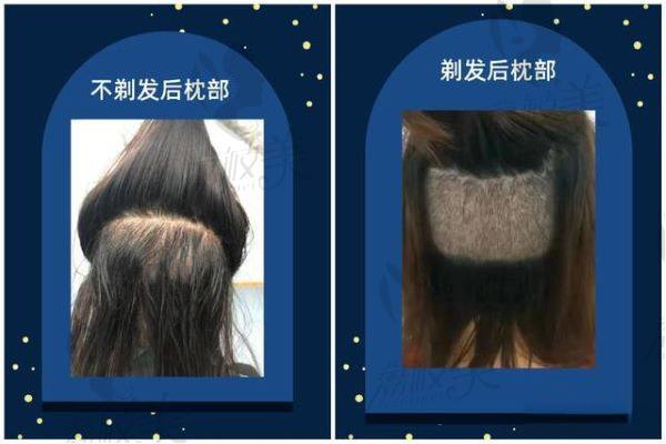 不剃发植发和剃发植发的区别
