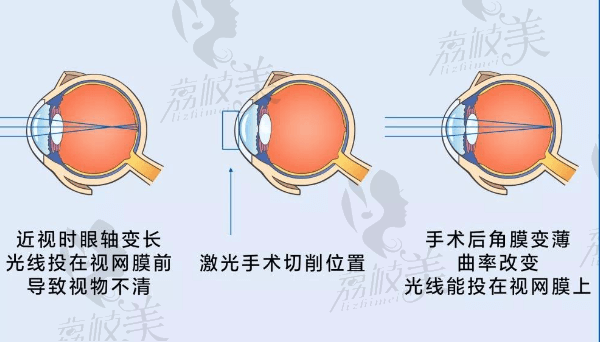 哈尔滨爱尔眼科医院的张焱医生怎么样？