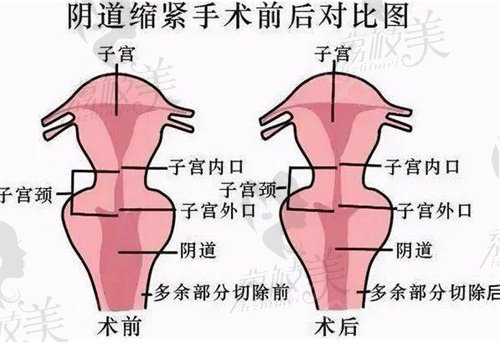 新型緊縮針能維持多久