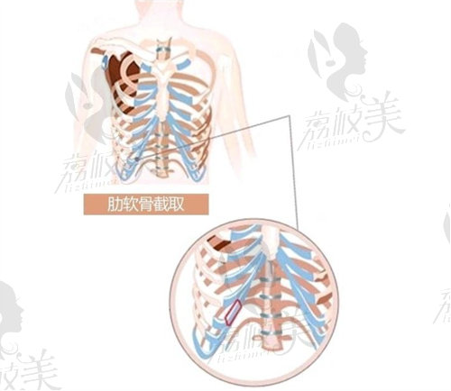 肋软骨隆鼻取肋示意图