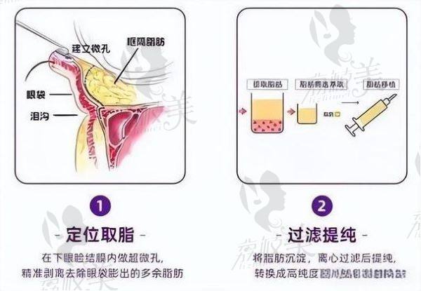 成都晶膚醫(yī)美祛眼袋怎么樣