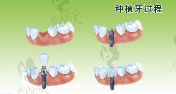 淮安牙知道口腔种植牙多少钱