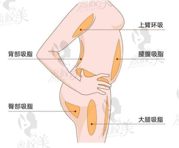 天津张红栓吸脂失败修复技术好