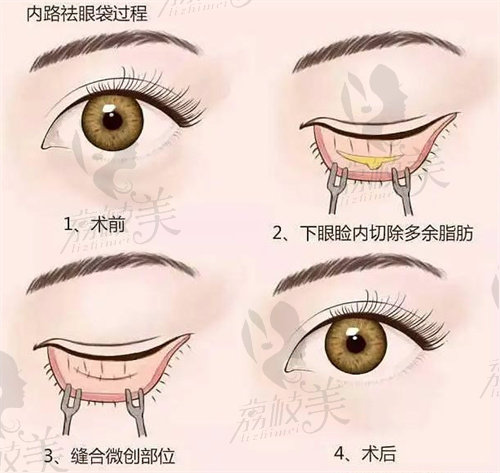 杜园园眼袋修复怎么样