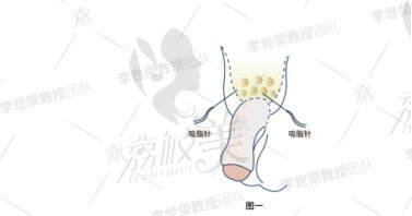 重庆李世荣做延长增粗三件套怎么样