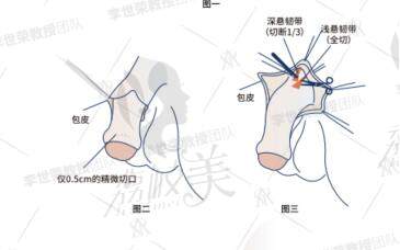 重慶李世榮做延長(zhǎng)增粗三件套怎么樣