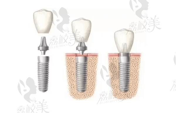 深圳美奧口腔楊忠醫(yī)生種植牙技術(shù)好