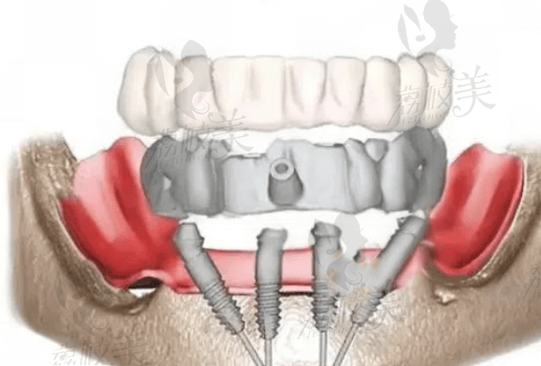 深圳美奥口腔半口即刻负重种植牙优势有哪些？