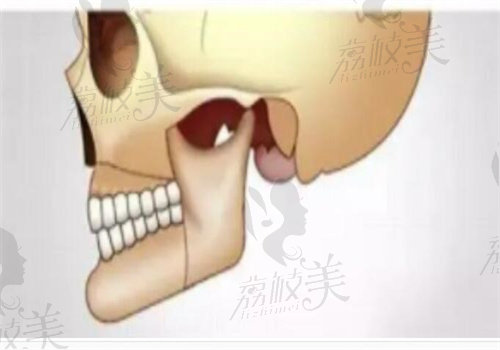 重庆王涛正颌手术多少钱