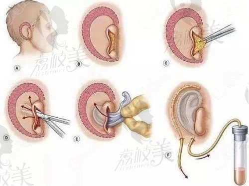 成都八大处耳再造实力医生