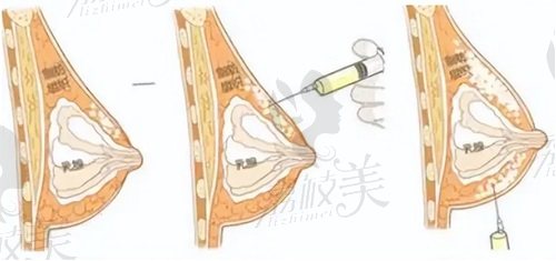 项力源医生自体脂肪丰胸怎么样