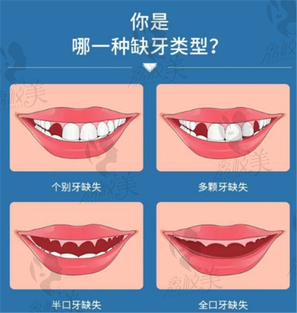 寧夏銀川諾貝爾口腔醫(yī)院種植5顆牙需要多少錢