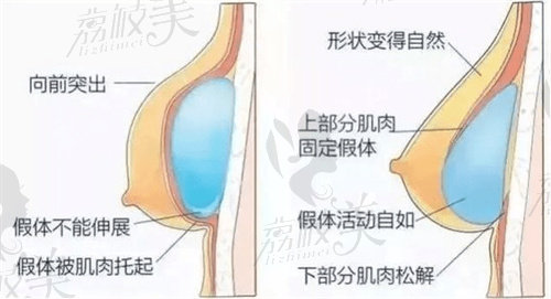 北京高超隆胸修复费用