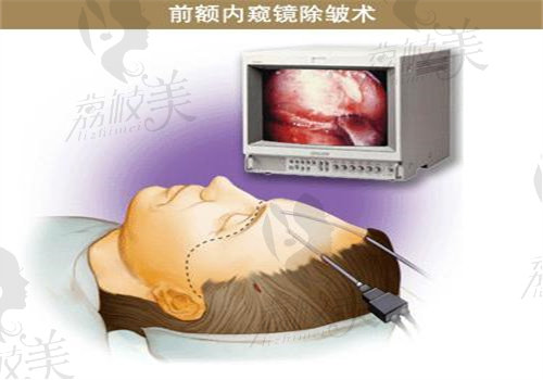 雷建波医生的无痕筋膜提升的口碑如何