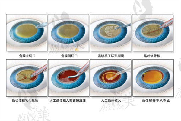 杭州茗視佳眼科晶體植入手術(shù)示意圖