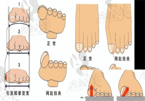 陈圣英医生大脚骨技术好