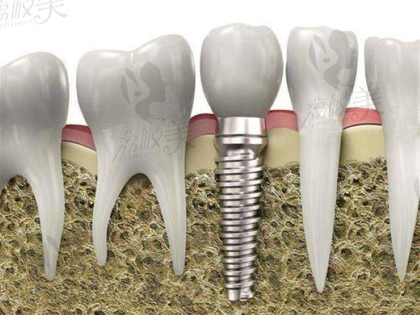 长春爱馨口腔种植牙多少钱