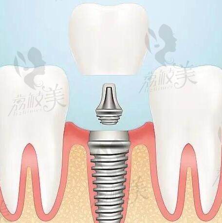 2000/3000/3800/6000/8000元的种植牙区别在哪里