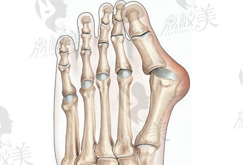 張澍醫(yī)生做大腳骨維持多久