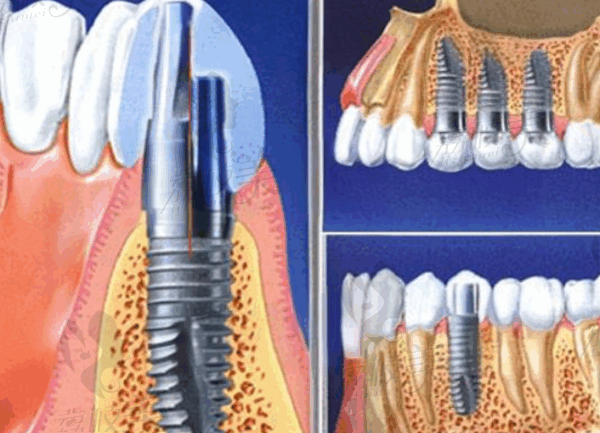 大理美伢口腔种植牙多少钱