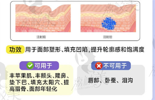 馨妍玻尿酸可以維持多久