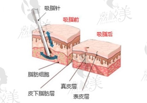 赵希军吸脂失败原因分析