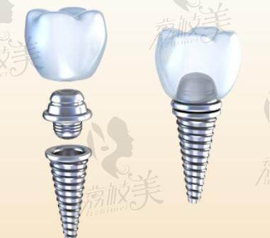 沈阳德立联合口腔数字化种植解决方案