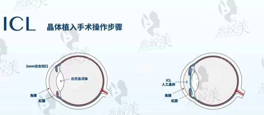 三焦点人工晶体植入费用2025