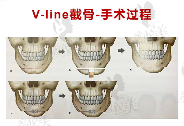 為什么選擇黃大勇院長(zhǎng)改臉型手術(shù)