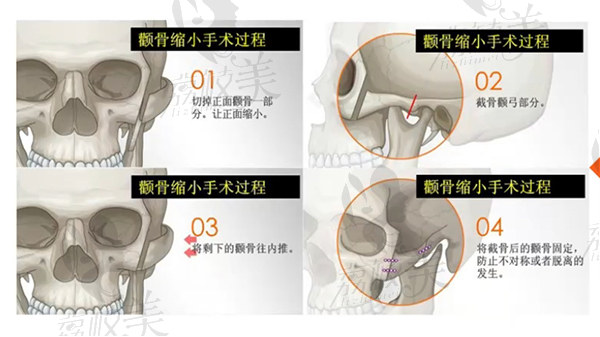 為什么選擇黃大勇院長(zhǎng)改臉型手術(shù)