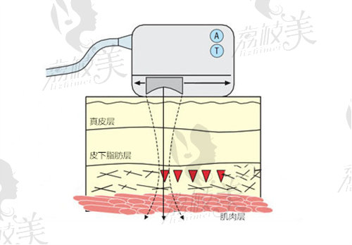 合肥福华热玛吉价格