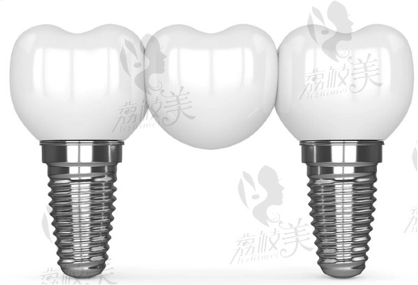 半口種植牙結(jié)束后注意事項(xiàng)有哪些