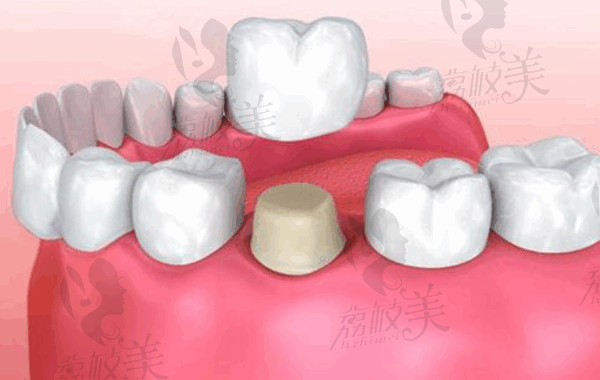 珠海九龙口腔医院威兰德全瓷牙冠多少钱