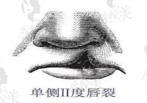 余文林唇裂修复怎么样