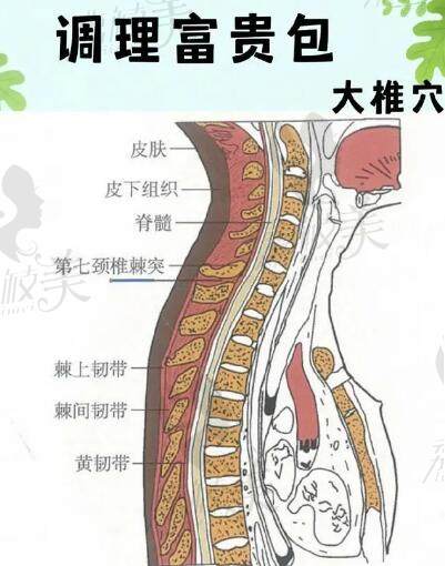 黃學(xué)峰一針去除富貴包是真是假謝謝