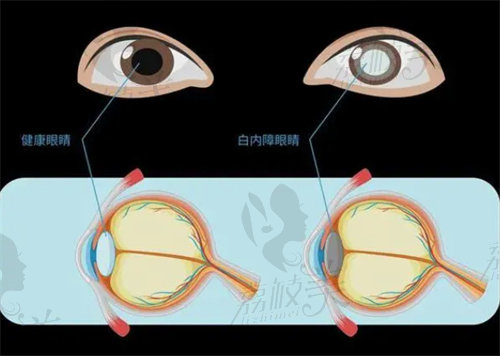 白内障免费手术申请条件