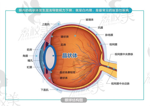 白内障免费政策