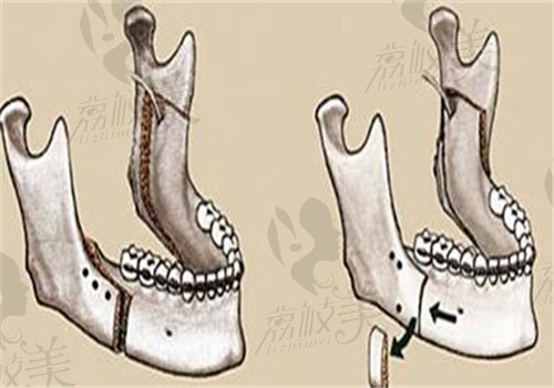 李繼華醫(yī)生正頜手術(shù)經(jīng)驗(yàn)多