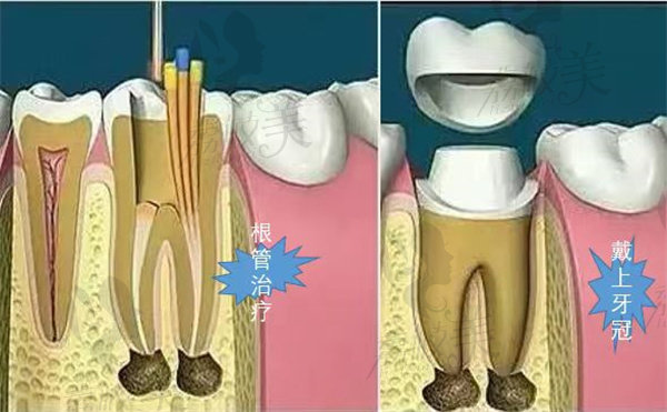 全瓷牙颜色与真牙相似