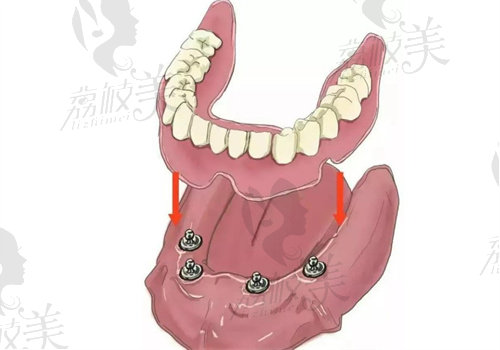 深圳卫佳康口腔医院孙连超怎么样